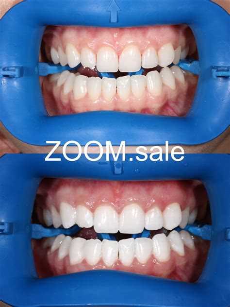 Принцип действия Zoom 4: роль геля и световой насадки